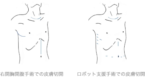 右開胸開腹手術での皮膚切開とロボット支援手術での皮膚切開の違い